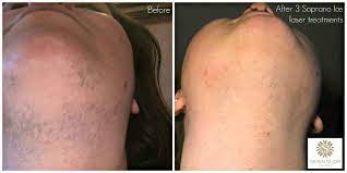 Unwanted hair can be a bane for many women, especially teenage girls still trying to understand their hormones. Laser Hair Removal Pcos The Skin To Love Clinic