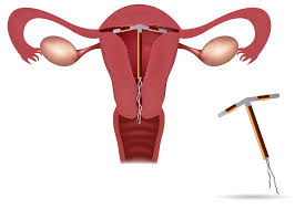 Occasionally, ultrasound is needed to guide iud insertion. Iud Insertion Santa Monica Iud Insertion Los Angeles