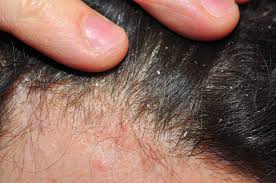 Psoriasis can mainly be found in persons ranging from ages 15 to 25 or 56 to 61. What Is Trichoclasis How Is It Best Managed