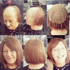 Hair Loss Dreamgirlz Hair Extensions