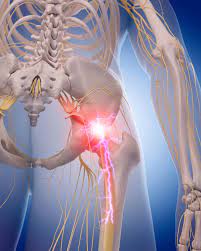 Sciatica And Sciatic Nerve Pain Information