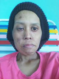 Pelbagai aktiviti diadakan seperti pemeriksaan percuma untuk kanser pangkal hidung dan juga seminar kesedaran berkenaan kanser pangkal hidung. Menderita Kanser Hidung Selepas Berpantang Wanita Ini Share Bagaimana Dia Sembuh Walaupun Buta Nona
