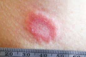 Maybe you would like to learn more about one of these? Mold On Skin Causes Symptoms Treatment Mold Blogger