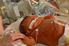 Necrotizing Enterocolitis Killed My Baby And Claims The Life Of Another Baby Every Day We Re Coming Together To Prevent This Deadly Neonatal Disease Nec Society