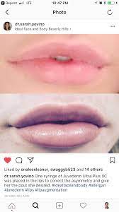 What are the potential side effects of juvéderm ® ultra plus xc? Repost Dr Sarah Yovino One Syringe Of Juvederm Ultra Plus Xc Was Placed In The Lips To Correct The Asymmetry And Face And Body Lip Augmentation Juvederm