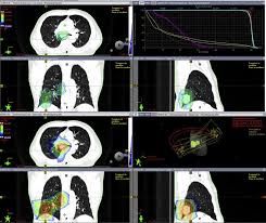 Some causes have more than one awareness color associated with them and are marked with an asterisk. Early Appearance Of Coronavirus Disease 2019 Associated Pulmonary Infiltrates During Daily Radiotherapy Imaging For Lung Cancer Journal Of Thoracic Oncology