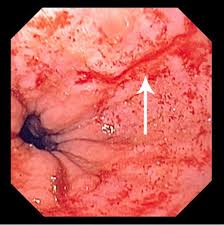 This is usually caused by severe vomiting because of alcoholism or bulimia. Mallory Weiss Syndrome Gastrointestinal Disorders Msd Manual Professional Edition