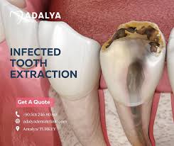 Image result for Tooth Extraction