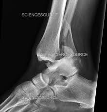 Image result for Ankle XRay