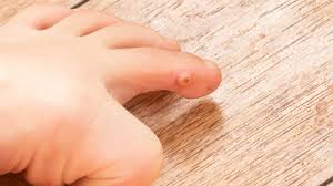 Sekiranya anda mengalami diabetes atau mengalami penyakit arteri periferal dan mempunyai ketulan kulit yang berlebihan di kaki. Penyebab Dan Cara Atasi Kutil Di Tubuh Anak
