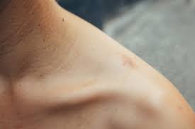 Assuming your skin is intact, there's no need to bandage a hickey. How To Cover Up A Hickey Without Concealer Fast 5 Minutes