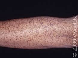 Image result for liver spots on legs