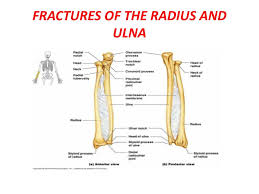 The lower arm consists of two bones extending from the elbow to the wrist, running the radius and ulna connect to the humerus bone of the upper arm at the elbow joint. Fractures Of The Radius And Ulna Ppt Download