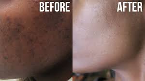 After a year of doing youtube and changing my lifestyle to be more healthy and organic, my body went into a crisis and broke out into all over body eczema. Skincare 101 How To Get Rid Of Dark Spots Essence