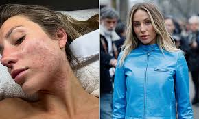 TikToker Alix Earle reveals what her skin really looks like without make-up  in candid post about acne struggle