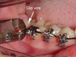 Do not attempt to cut the wire, because you might accidentally swallow it or inhale it into your lungs. Emergency Care Goldreich Orthodontics Plano Tx