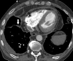 Classically seen in empyema, hemothorax. Contrast Enhanced Transverse Axial Ct Image Of The Lower Thorax Download Scientific Diagram