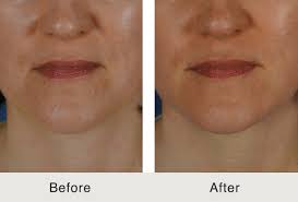 We did not find results for: Jawline And Marionette Line Fillers Charlotte Nc Carolina Facial Plastics