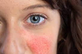 Systemic lupus erythematosus (sle) is a chronic inflammatory disease that has protean manifestations and follows a relapsing and remitting course. Lupus Erythematosus Treatment Lehi Utah Smart Skin Dermatology