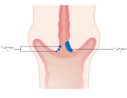 File Diagram Showing Stage 1a Cervical Cancer Cruk 200 Ar Png Wikimedia Commons