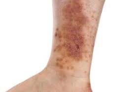 Image result for Pigment stains on the shin