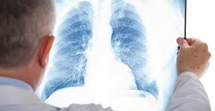 Maybe you would like to learn more about one of these? How Mesothelioma And Lung Cancer Hide From Early Detection