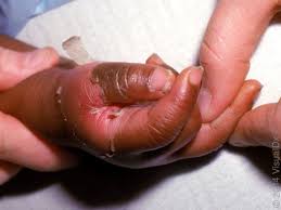 What causes baby skin peeling? Another Potential Dark Side Of Covid 19 Affecting Children