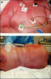 Staphylococcal Scalded Skin Syndrome The American Journal Of Medicine