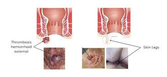 Image result for hemoroid human