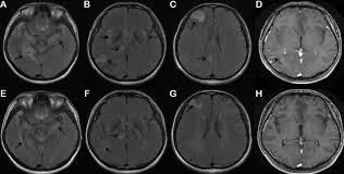 Image result for Neurosyphilis