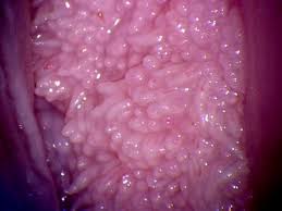 Vestibular Papillomatosis Confused To Genital Warts In A Pregnant Woman