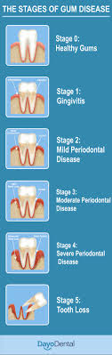 Although periodontal disease is a major cause of gingival recession, it's not the. Your Ultimate Guide To Periodontal Disease Periodontitis