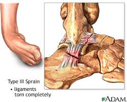 We did not find results for: Pin On Ankle Tear