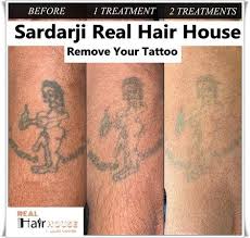 Does laser tattoo removal leave scars? Want To Remove Old Fashion Tattoo Its Possible Now Permanent Laser Tattoo Removal With No