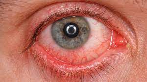 It's possible through the eyes, but not likely through the ears. Coronavirus Update Pink Eye Could Be Rare Symptom Of Covid 19 Doctors Say Abc7 San Francisco