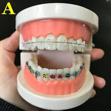 Dental Orthodontic Education Study Teeth Model W Brackets Arch Wire Buccal Tube Unbranded Orthodontics Dental Orthodontic Treatment