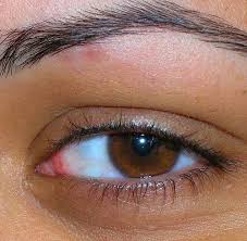 What Are The Treatments For A Swollen Itchy Eyelid Ehow Itchy Eyelids Puffy Eyes Swollen Eyelids Remedy