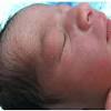 A 6 days old baby boy was brought to emergency with blackish ulcers all over the body. 1
