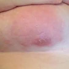 Abzess Oder Doch Was Anderes Gesundheit Und Medizin Haut Entzundung