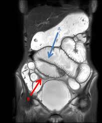 Image result for Radiation Colitis