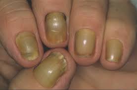 Image result for Yellow nail syndrome feet
