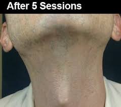 View some of our laser hair removal before and after pictures of actual patients. Laser Hair Removal Before And After Pictures Wifh