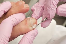 Comment Soigner Un Ongle Incarne Poderm