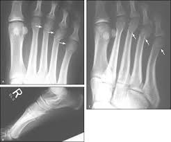 If the surgeon is concerned that the. Metatarsal Fractures Physiopedia