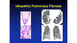 Interstitial Lung Disease In Scleroderma Youtube