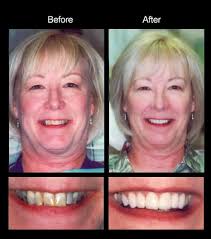 Cerritos Dentist Smile Gallery-Dr. Jay Azling