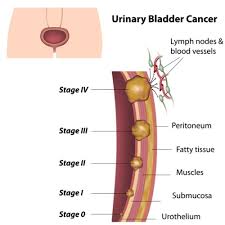 Other symptoms of advanced bladder cancer may include pain in the back or pelvis, unexplained appetite loss, and weight loss. Bladder Cancer Symptoms And Causes I Fashion Styles
