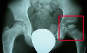 Treatment is typically observation in children less than 8 years of age, and femoral and/or pelvic. Morbus Perthes