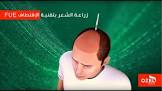 دليل مراكز زراعة الشعر في تركيا Wtclinic.com