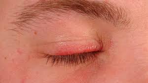 This edema is granulomatous in nature, thought to be due to chronic inflammation of the cutaneous vessels. Solid Facial Edema In Rosacea Altmeyers Encyclopedia Department Dermatology